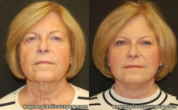 Eyelid Surgery Before and After photo by Dr. Jeffrey Wagner in Indianapolis, IN