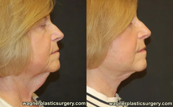Neck Lift Before and After photo by Dr. Jeffrey Wagner in Indianapolis, IN