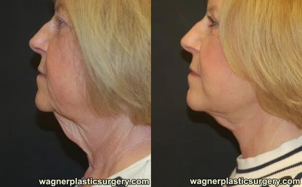 Neck Lift Before and After photo by Dr. Jeffrey Wagner in Indianapolis, IN
