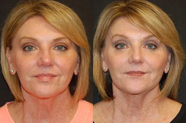 Injectables Before and After photo by Dr. Jeffrey Wagner in Indianapolis, IN