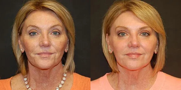CO Laser Before and After photo by Dr. Jeffrey Wagner in Indianapolis, IN