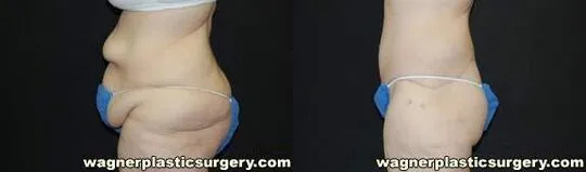 Body Lift Before and After photo by Dr. Jeffrey Wagner in Indianapolis, IN