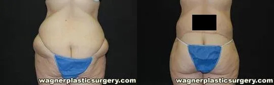 Body Lift Surgery After Weight Loss Before and After photo by Dr. Jeffrey Wagner in Indianapolis, IN