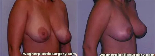 Breast Lift Surgery After Weight Loss Before and After photo by Dr. Jeffrey Wagner in Indianapolis, IN