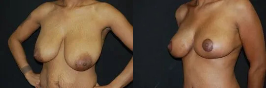 Breast Lift Surgery After Weight Loss Before and After photo by Dr. Jeffrey Wagner in Indianapolis, IN