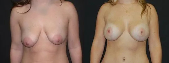 Breast Lift Before and After photo by Dr. Jeffrey Wagner in Indianapolis, IN