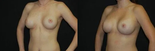 Breast Augmentation Revision Before and After photo by Dr. Jeffrey Wagner in Indianapolis, IN