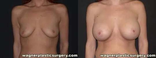 Breast Augmentation Before and After photo by Dr. Jeffrey Wagner in Indianapolis, IN
