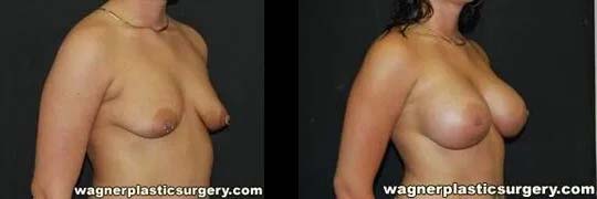 Breast Augmentation Before and After photo by Dr. Jeffrey Wagner in Indianapolis, IN
