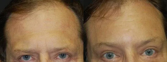 Brow Lift Before and After photo by Dr. Jeffrey Wagner in Indianapolis, IN