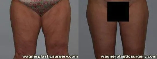 Thigh Lift Before and After photo by Dr. Jeffrey Wagner in Indianapolis, IN