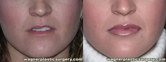 Lip Enhancement Before and After photo by Dr. Jeffrey Wagner in Indianapolis, IN