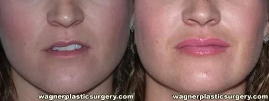 Lip Enhancement Before and After photo by Dr. Jeffrey Wagner in Indianapolis, IN