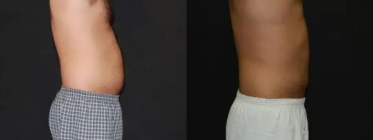 Liposuction for Men Before and After photo by Dr. Jeffrey Wagner in Indianapolis, IN