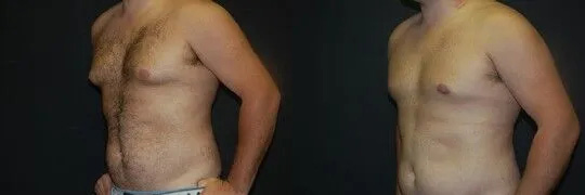 Gynecomastia Before and After photo by Dr. Jeffrey Wagner in Indianapolis, IN