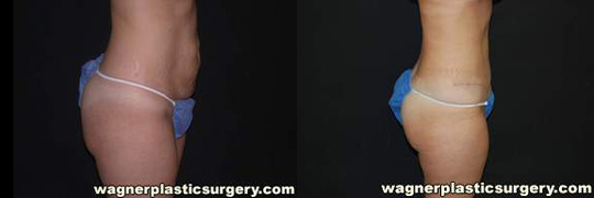 Tummy Tuck Before and After photo by Dr. Jeffrey Wagner in Indianapolis, IN