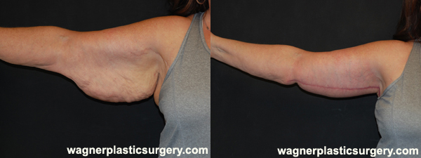 Arm Lift Before and After photo by Dr. Jeffrey Wagner in Indianapolis, IN