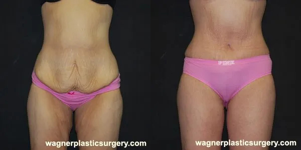 Thigh Lift Before and After photo by Dr. Jeffrey Wagner in Indianapolis, IN