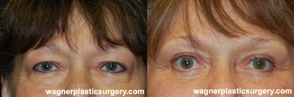 Brow Lift Before and After photo by Dr. Jeffrey Wagner in Indianapolis, IN