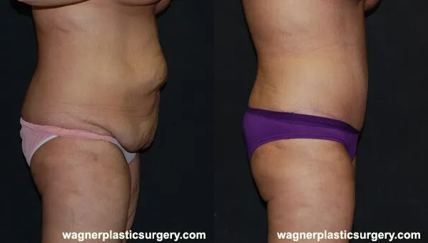 Body Lift Surgery After Weight Loss Before and After photo by Dr. Jeffrey Wagner in Indianapolis, IN