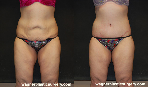 Body Lift Before and After photo by Dr. Jeffrey Wagner in Indianapolis, IN