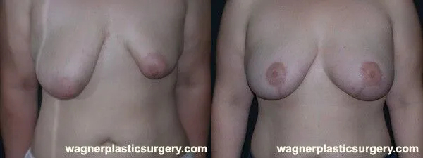 Breast Reconstruction Before and After photo by Dr. Jeffrey Wagner in Indianapolis, IN
