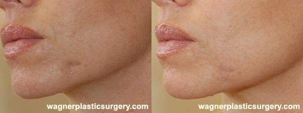 Wrinkle Fillers Before and After photo by Dr. Jeffrey Wagner in Indianapolis, IN