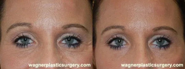 Botox Before and After photo by Dr. Jeffrey Wagner in Indianapolis, IN