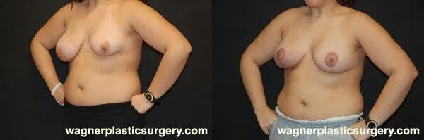 Breast Reconstruction Before and After photo by Dr. Jeffrey Wagner in Indianapolis, IN
