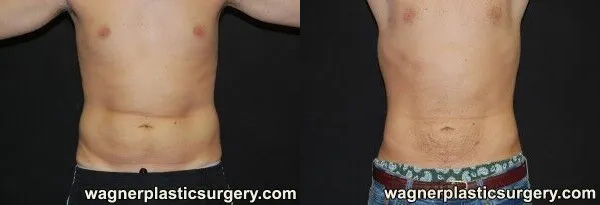Liposuction for Men Before and After photo by Dr. Jeffrey Wagner in Indianapolis, IN