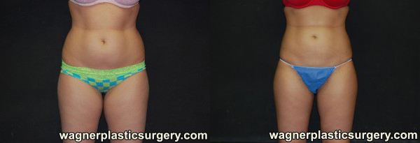 Liposuction Before and After photo by Dr. Jeffrey Wagner in Indianapolis, IN