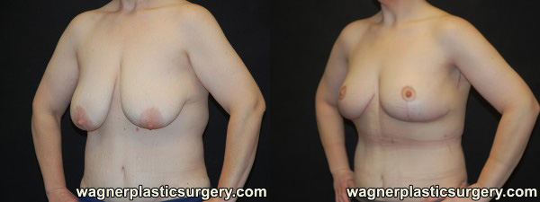Breast Lift Before and After photo by Dr. Jeffrey Wagner in Indianapolis, IN