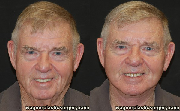 Facelift Before and After photo by Dr. Jeffrey Wagner in Indianapolis, IN