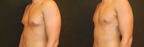 Gynecomastia Before and After photo by Dr. Jeffrey Wagner in Indianapolis, IN