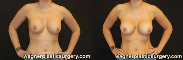 Breast Augmentation Revision Before and After photo by Dr. Jeffrey Wagner in Indianapolis, IN