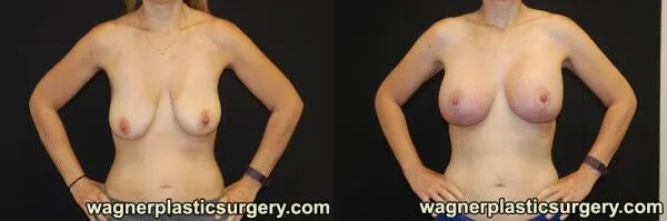 Breast Lift with Augmentation Before and After photo by Dr. Jeffrey Wagner in Indianapolis, IN