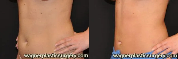 Liposuction Before and After photo by Dr. Jeffrey Wagner in Indianapolis, IN