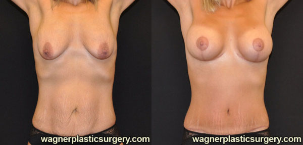 Mommy Makeover Before and After photo by Dr. Jeffrey Wagner in Indianapolis, IN