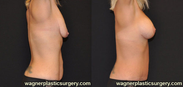 Mommy Makeover Before and After photo by Dr. Jeffrey Wagner in Indianapolis, IN