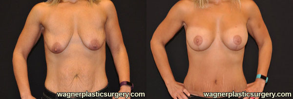 Breast Lift with Augmentation Before and After photo by Dr. Jeffrey Wagner in Indianapolis, IN