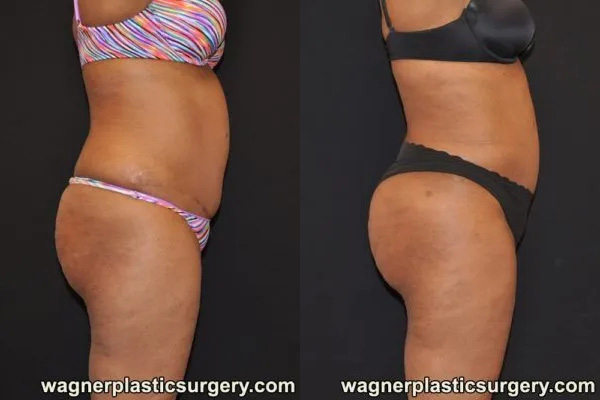 Buttock Augmentation Fat Transfer Before and After photo by Dr. Jeffrey Wagner in Indianapolis, IN