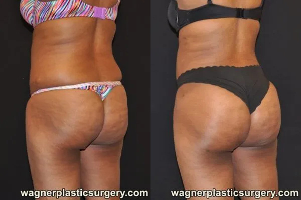 Buttock Augmentation Fat Transfer Before and After photo by Dr. Jeffrey Wagner in Indianapolis, IN
