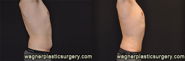 Tummy Tuck Before and After photo by Dr. Jeffrey Wagner in Indianapolis, IN