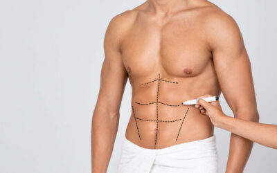 Sculpting a Masculine Figure with Liposuction